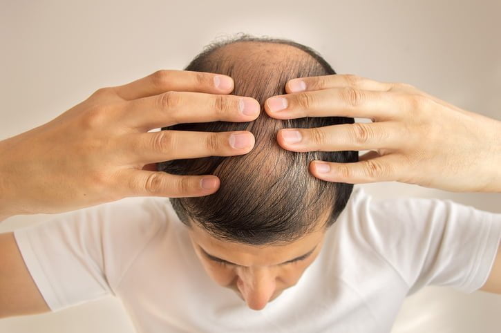 Is Permanent Hair Loss Caused By Taxotere Grounds for a Case?