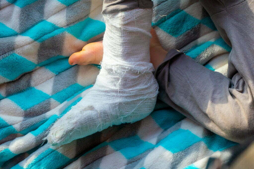 Child With Bandage On Leg Heel Fracture Broken Ri 2022 10 07 22 00 52 Utc 1024x683